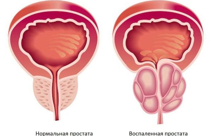 imunolog prostatita biopsia de prostata sin sedacion