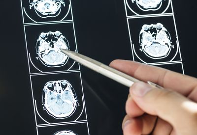 Мультиспиральная томография головного мозга