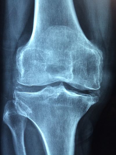 Рентген коленного сустава в Красноярске