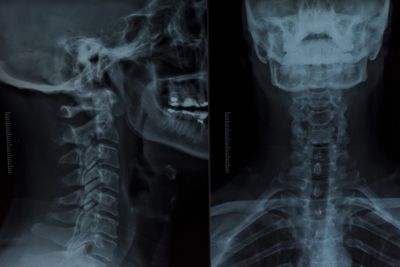 Рентген шейного отдела позвоночника