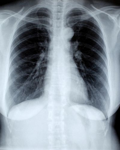 Рентгенография легких 