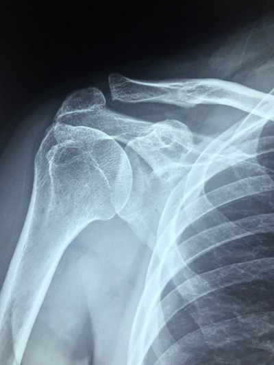 Рентген плечевого сустава в Красноярске