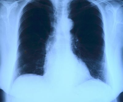 Рентген грудной клетки