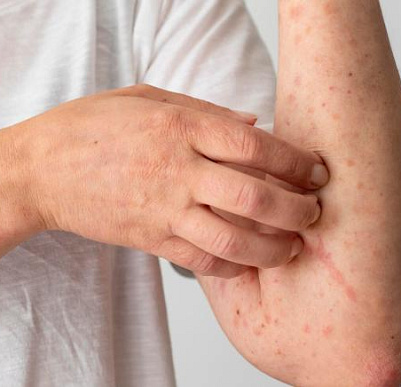 Симптомы и лечение аллергической крапивницы