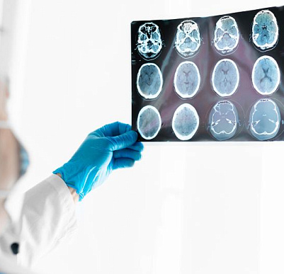 Что означают пятна на МРТ головного мозга?